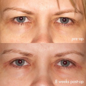 upper eyelid blepharoplasty