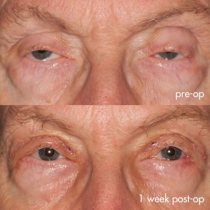 Droopy eyelids