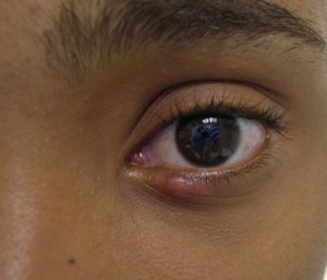 Stye (external hordeolum)