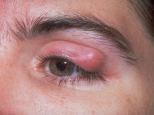 chalazion