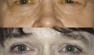 Before and after blepharoplasty