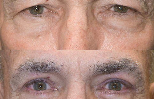 Browpexy and blepharoplasty