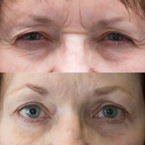 Endoscopic brow lift with upper and lower blepharoplasty