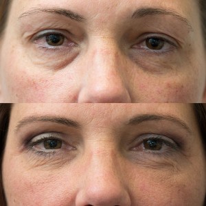 Upper and lower eyelid blepharoplasty