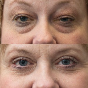 Upper and lower blepharoplasty