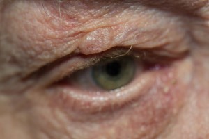 Eyelid skin cancer basal cell carcinoma