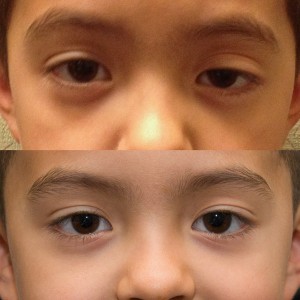 congenital ptosis
