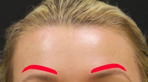 direct brow lift incisions