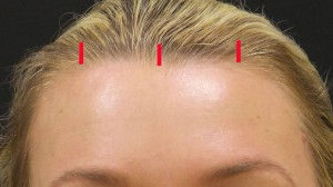 Endoscopic brow lift incisions