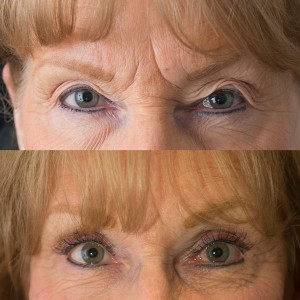 Endoscopic brow lift