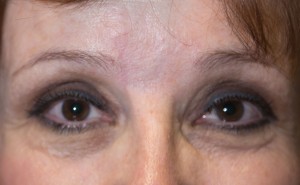 After facial scar revision