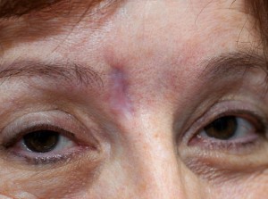 Before facial scar revision