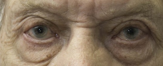 Eyelid surgery in older age