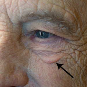 cheek festoons