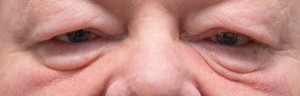 cheek festoons