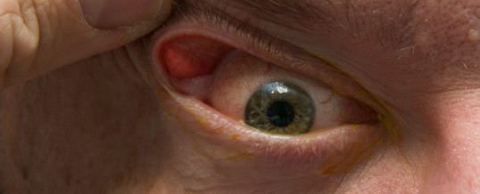 Floppy eyelid syndrome and sleep apnea