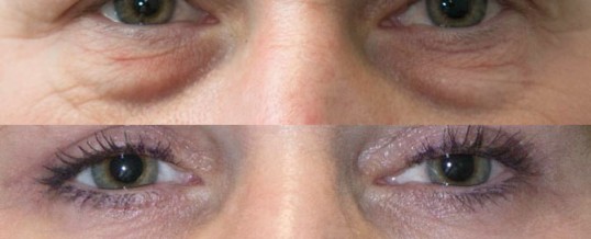 Lower eyelid blepharoplasty: FAQs answered