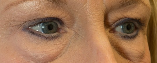 Lower eyelid blepharoplasty: What are the best techniques available?