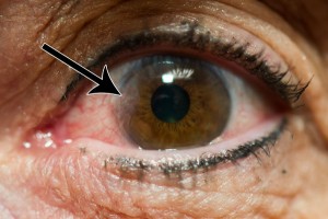 pterygium