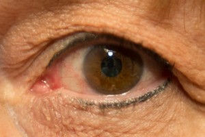 Pterygium surgery post op